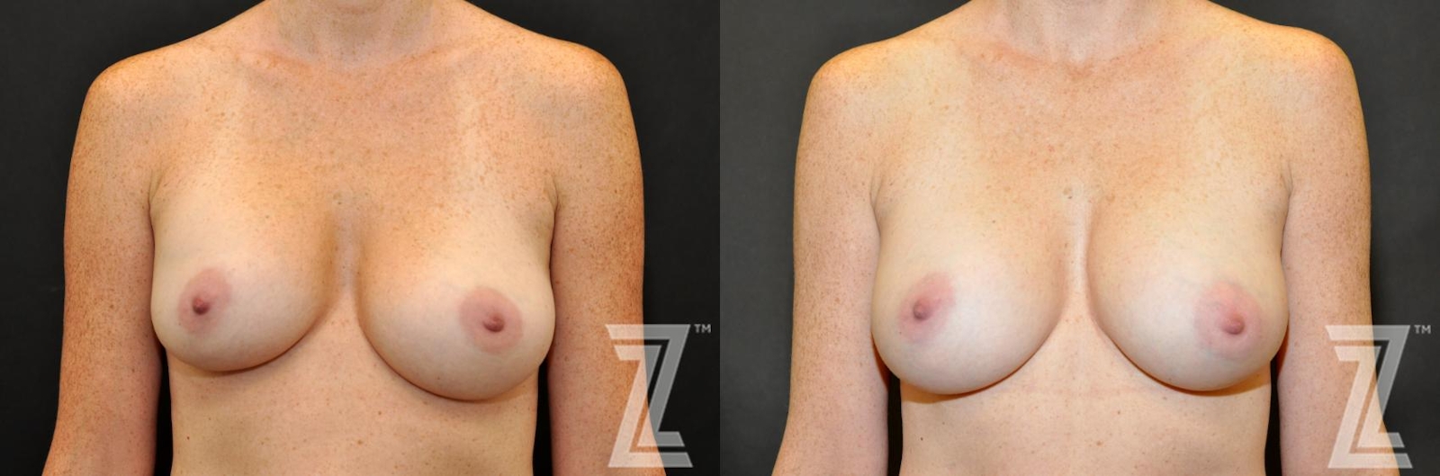 Austin Breast Augmentation Revision Before & After Gallery - Patient 132886587 - Image 1 - The Piazza Center