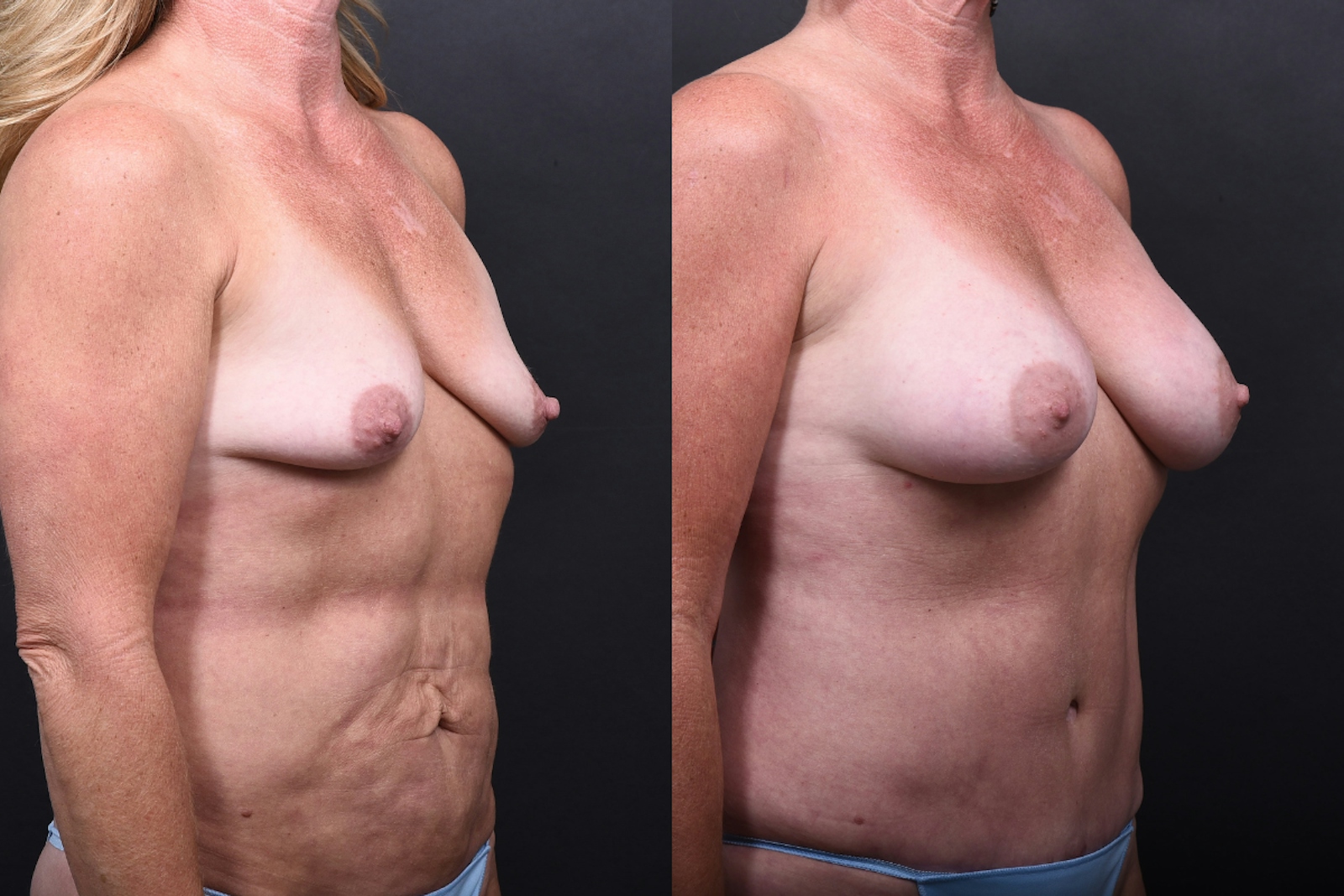 Austin Breast Augmentation Before & After Gallery - Patient 158035 - Image 2 - The Piazza Center