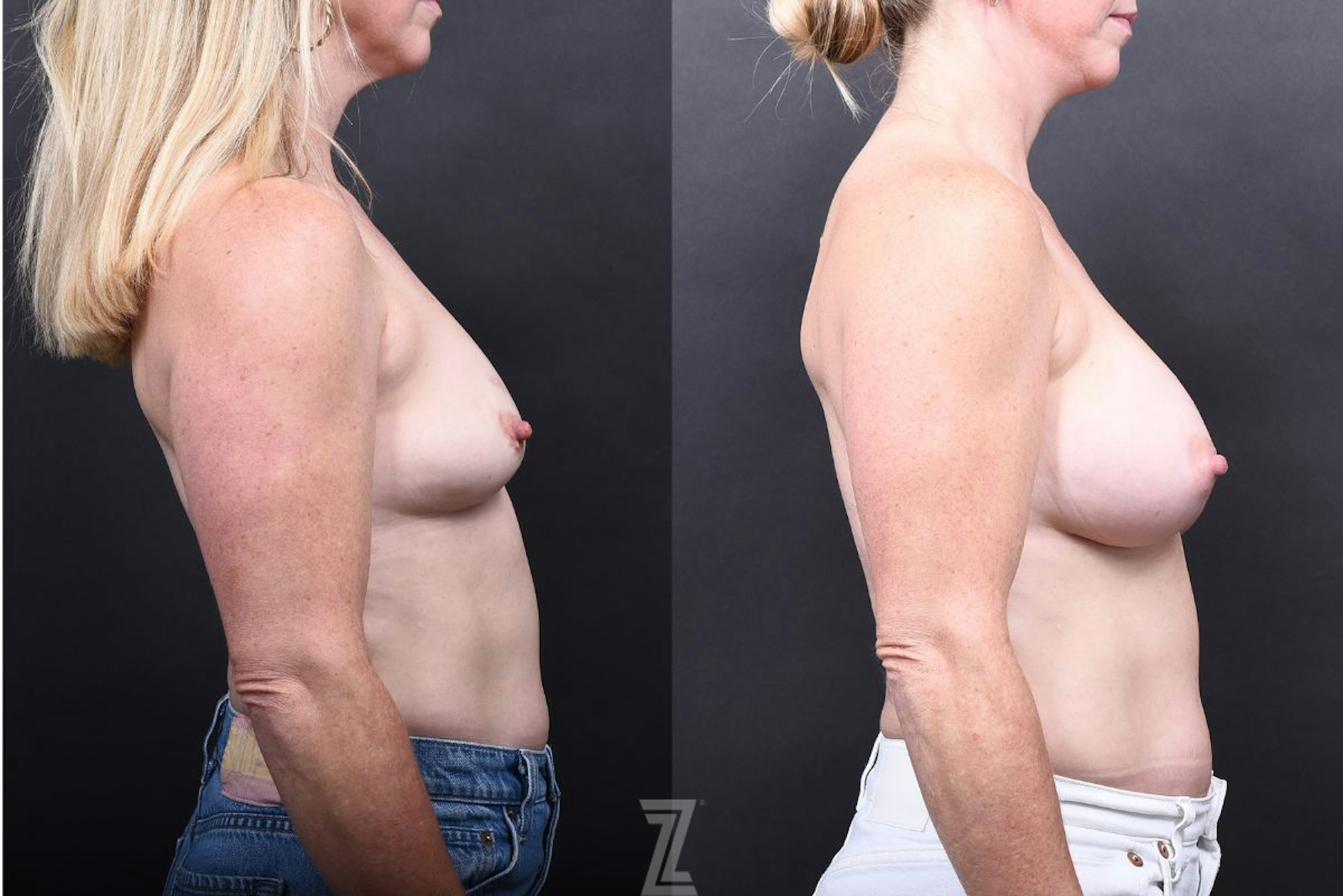 Austin Breast Augmentation Before & After Gallery - Patient 133398 - Image 3 - The Piazza Center