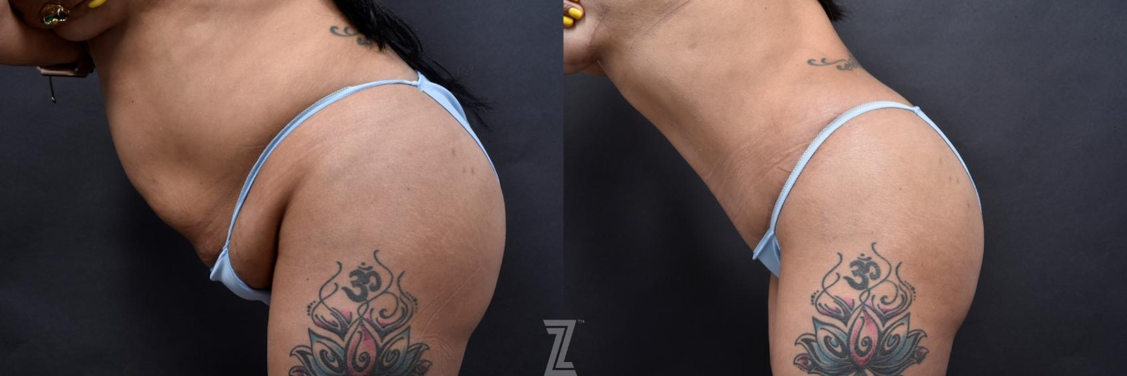 Austin Lateral Abdomen View in Flexion 6 Month Post-OP Mommy Makeover in Austin, TX by Dr. Rocco Piazza - The Piazza Center