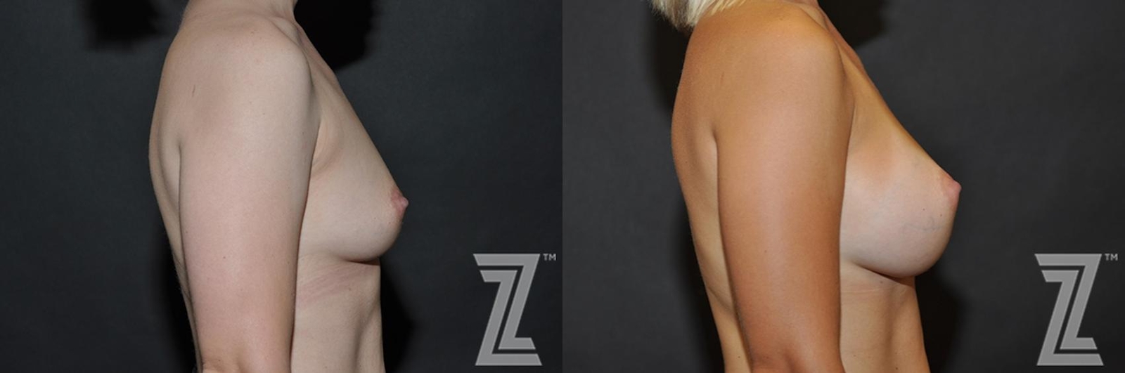 Austin 6 Months After Breast Augmentation in Austin, TX Before & After by Dr. Rocco Piazza - Lateral View - The Piazza Center