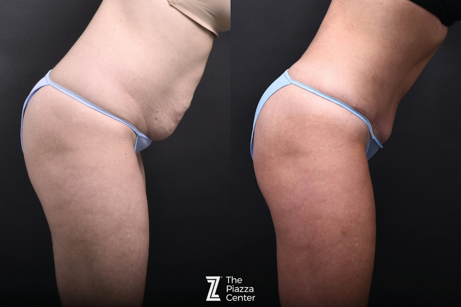 Austin Tummy Tuck Before & After Gallery - Patient 957209 - Image 3 - The Piazza Center
