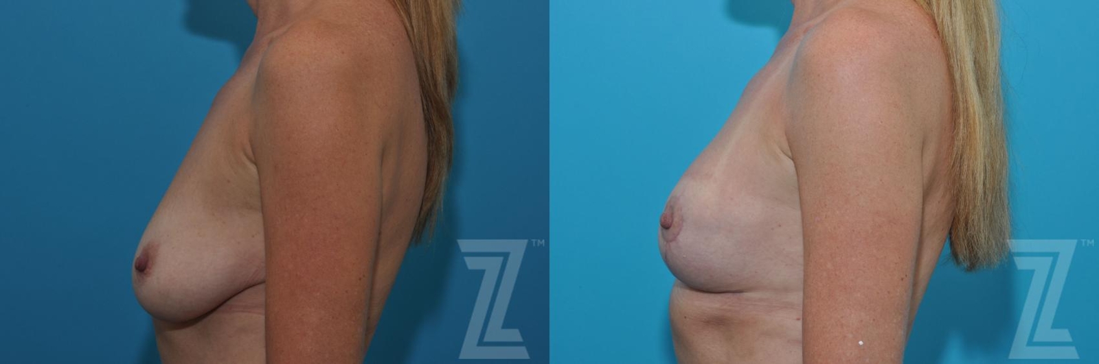 Austin Breast Lift Before & After Gallery - Patient 132791081 - Image 3 - The Piazza Center