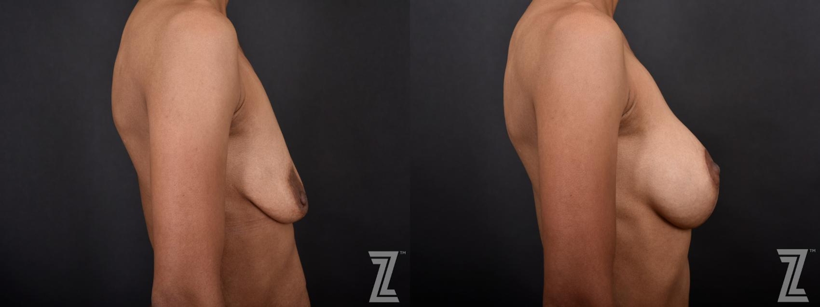 Austin 34-Year-Old Mother of Three Children's Mommy Makeover Before & After by Dr. Rocco Piazza in Austin, Texas - Oblique View of Breasts - The Piazza Center