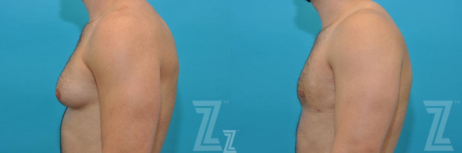 Austin Gynecomastia/Male Breast Reduction Before & After Gallery - Patient 118963 - Image 3 - The Piazza Center