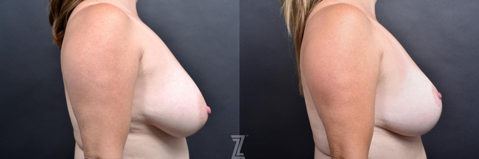 Austin Breast Lift Before & After Gallery - Patient 132791077 - Image 5 - The Piazza Center
