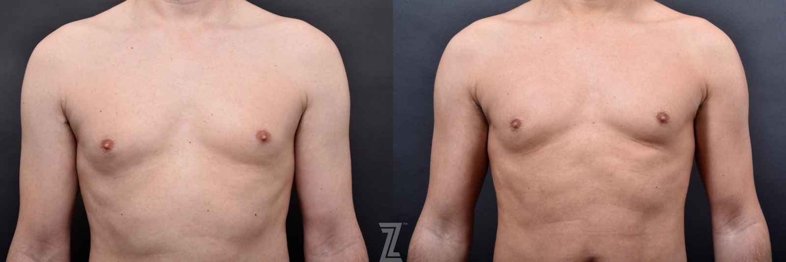 Austin Male Body Contouring Before & After Gallery - Patient 273342 - Image 4 - The Piazza Center