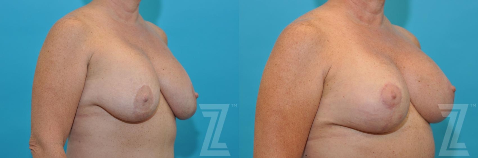 Austin Breast Augmentation Revision Before & After Gallery - Patient 132886540 - Image 4 - The Piazza Center