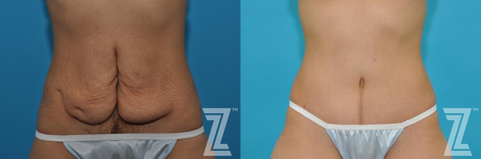 Austin Tummy Tuck Before & After Gallery - Patient 132886797 - Image 1 - The Piazza Center
