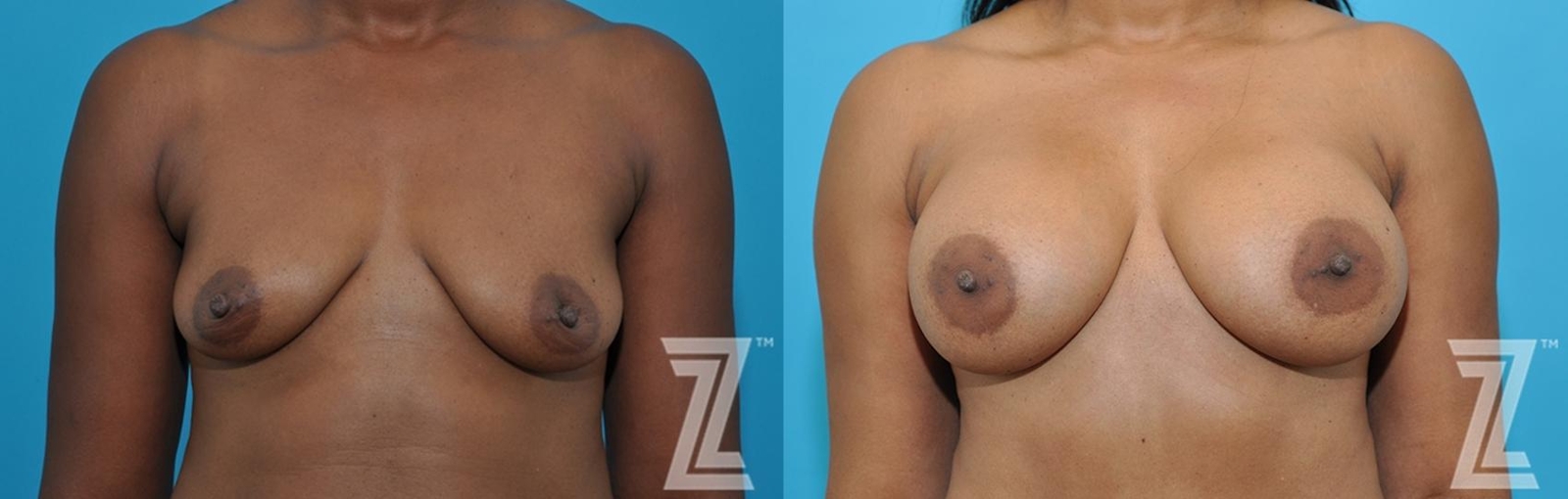 Austin Frontal breast view of 43-year-old mother of two mommy maker over - Dr. Rocco Piazza - The Piazza Center