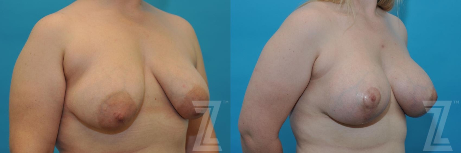 Austin Correction of Breast Asymmetry Before & After Gallery - Patient 132886777 - Image 4 - The Piazza Center
