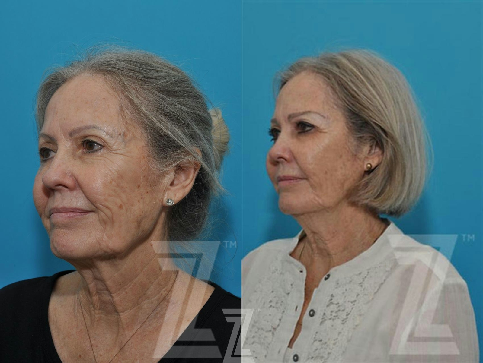 Austin Sculptra® Before & After Gallery - Patient 132963132 - Image 2 - The Piazza Center