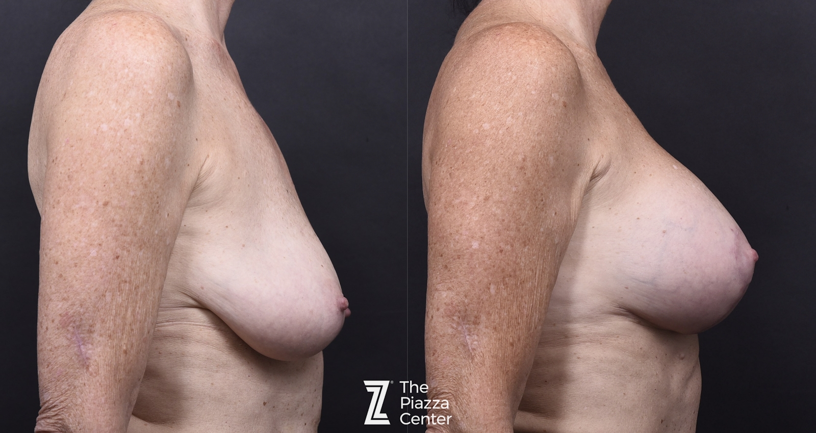 Austin Breast Augmentation Before & After Gallery - Patient 287263 - Image 3 - The Piazza Center