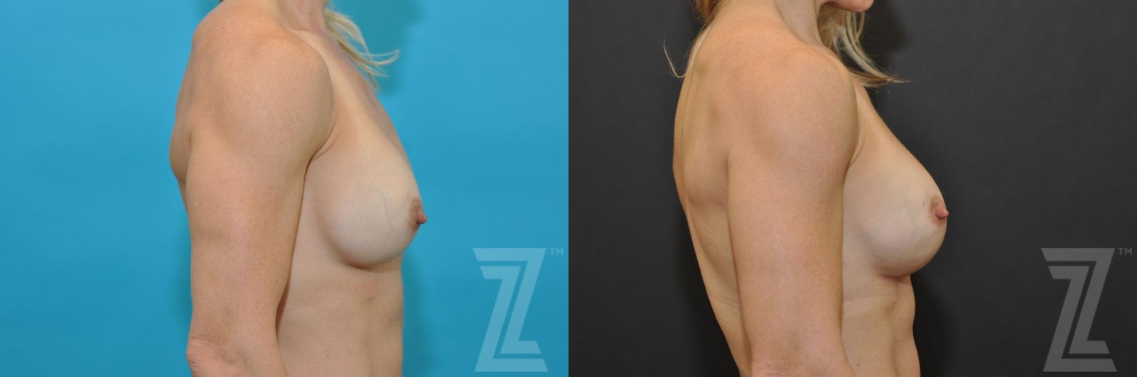 Austin Breast Augmentation Revision Before & After Gallery - Patient 132886580 - Image 5 - The Piazza Center