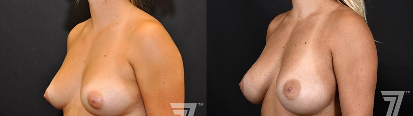 Austin Oblique view of before and after 2 year post op 23 year old woman with breast augmentation - The Piazza Center