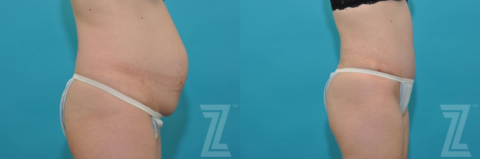 Austin Tummy Tuck Before & After Gallery - Patient 132886890 - Image 4 - The Piazza Center