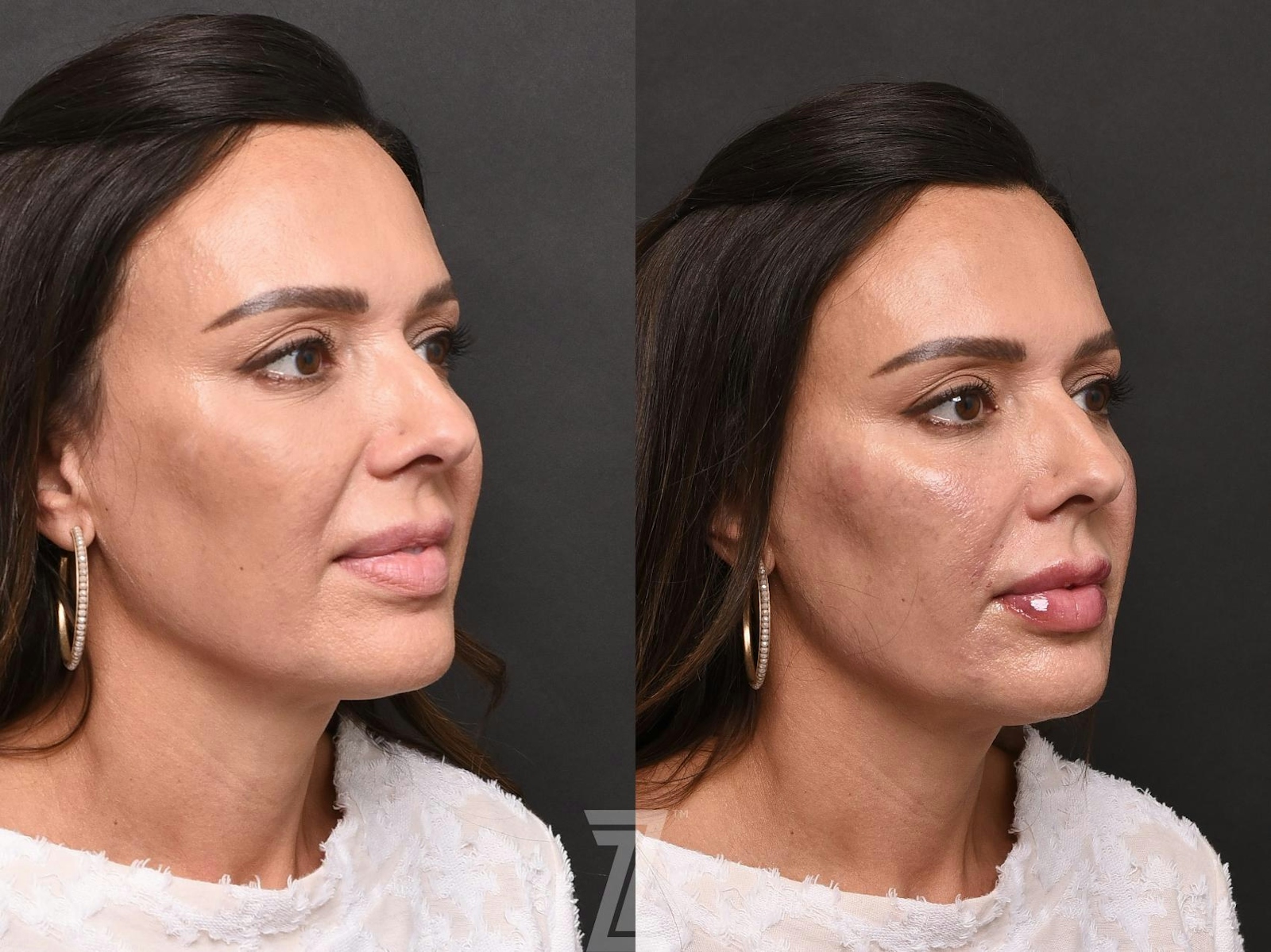 Austin Injectable Fillers Before & After Gallery - Patient 132963109 - Image 3 - The Piazza Center