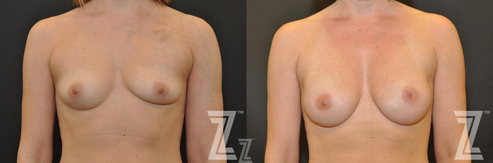 Austin Breast Reconstruction Before & After Gallery - Patient 132886763 - Image 1 - The Piazza Center