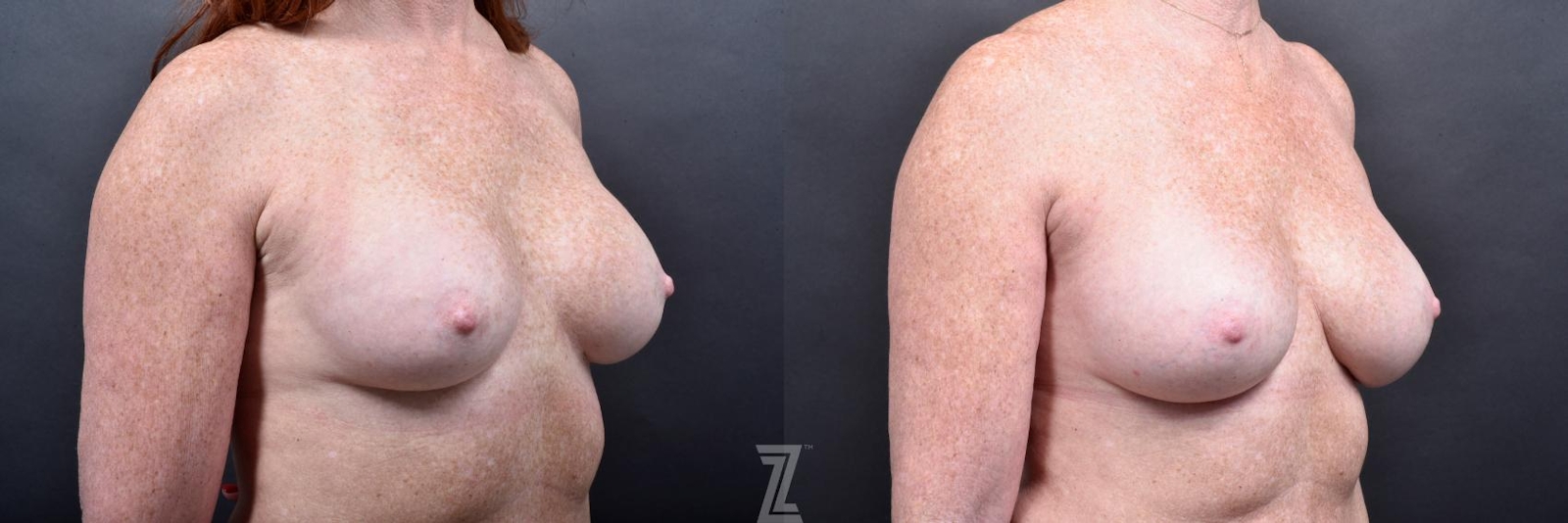 Austin Breast Augmentation Revision Before & After Gallery - Patient 132886568 - Image 4 - The Piazza Center