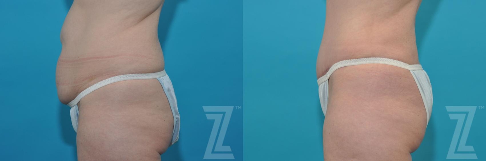 Austin Tummy Tuck Before & After Gallery - Patient 132886874 - Image 3 - The Piazza Center