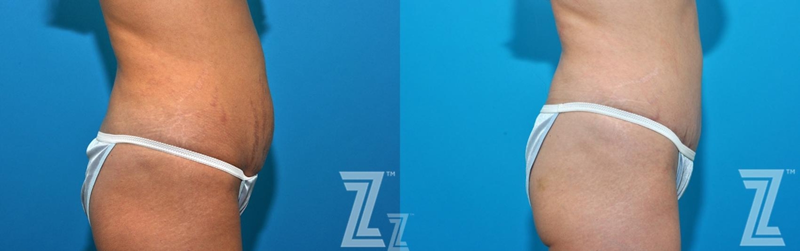 Austin 36 year old woman 1 year post op lateral view mommy makeover - Austin Tx, The Piazza Center - The Piazza Center