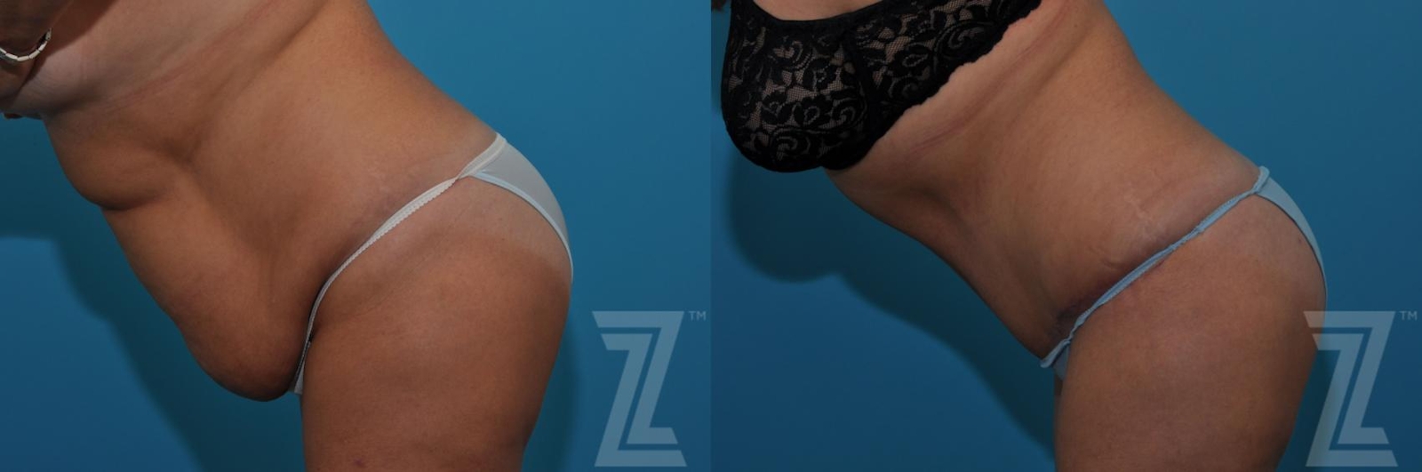 Austin Tummy Tuck Before & After Gallery - Patient 132886809 - Image 4 - The Piazza Center