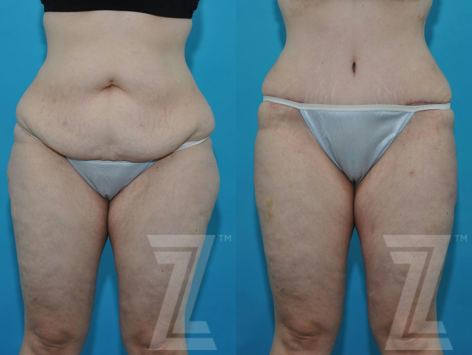 Austin Tummy Tuck Before & After Gallery - Patient 132886824 - Image 7 - The Piazza Center
