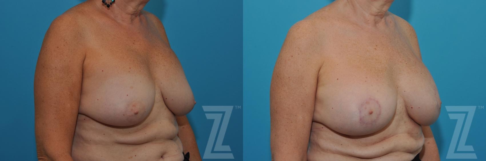Austin Breast Augmentation Revision Before & After Gallery - Patient 132886586 - Image 4 - The Piazza Center