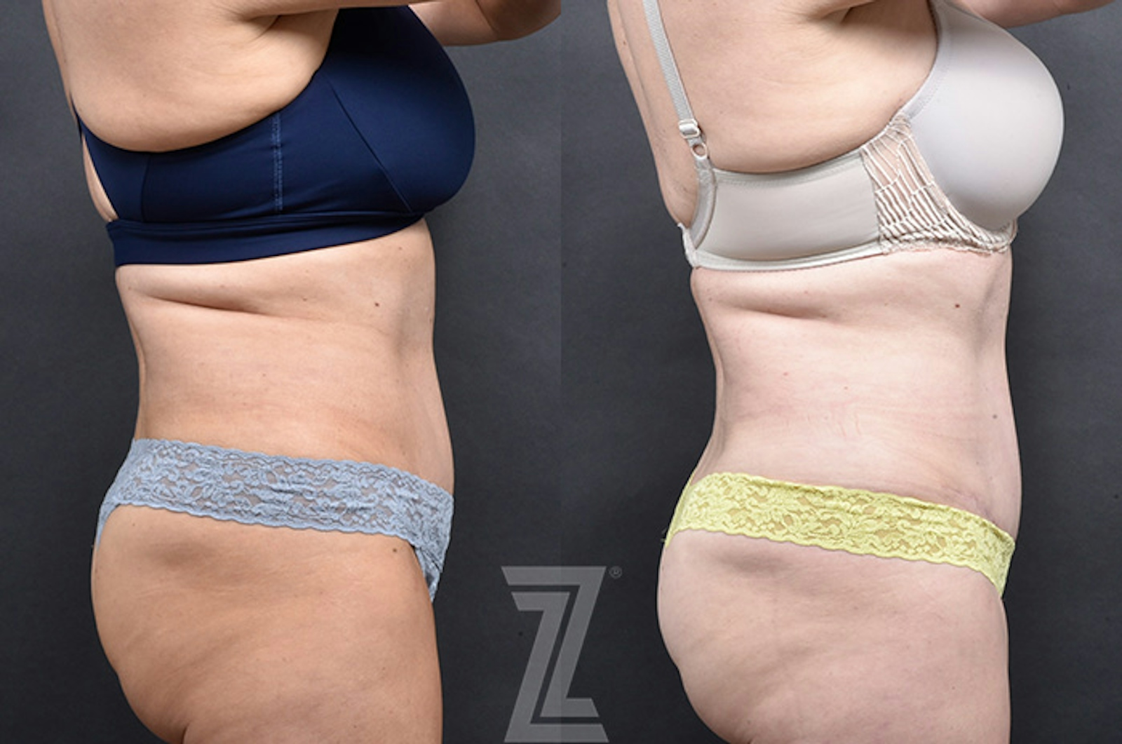 Austin Emsulpt Neo® Before & After Gallery - Patient 126155 - Image 3 - The Piazza Center