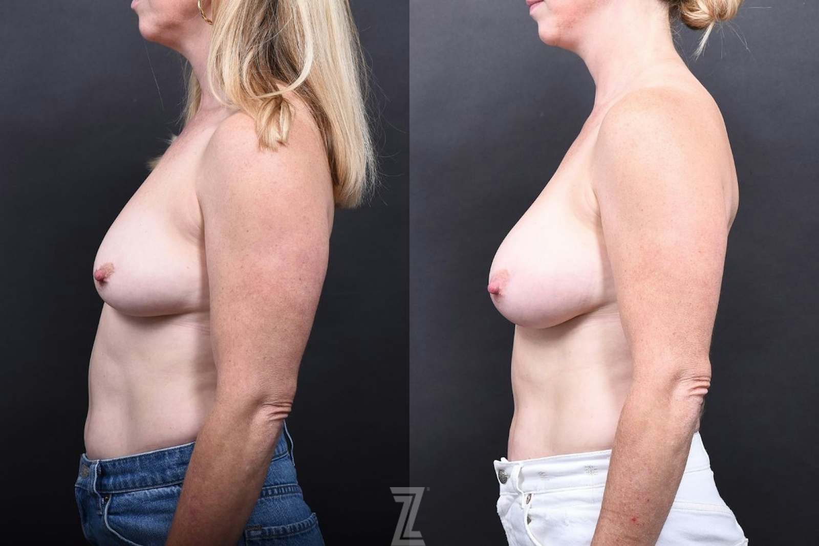 Austin Breast Augmentation Before & After Gallery - Patient 327344 - Image 5 - The Piazza Center