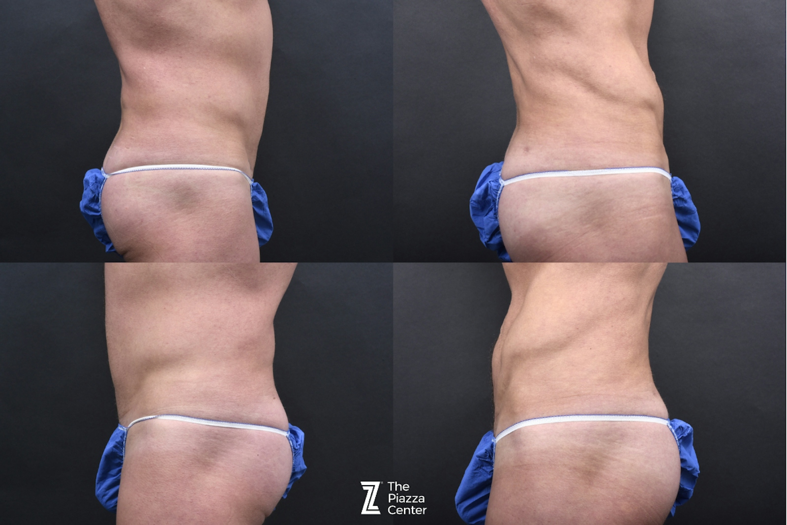 Austin Male Body Contouring Before & After Gallery - Patient 219361 - Image 8 - The Piazza Center