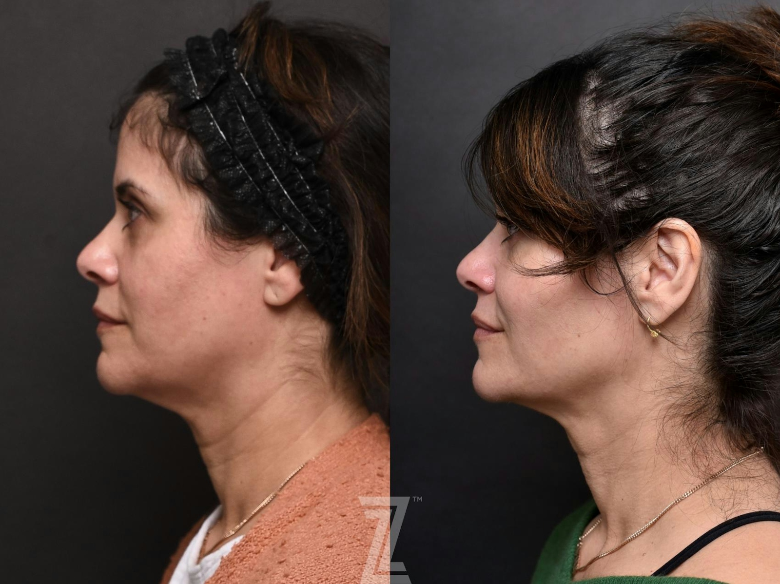 Austin Facial Rejuvenation Before & After Gallery - Patient 189397 - Image 2 - The Piazza Center