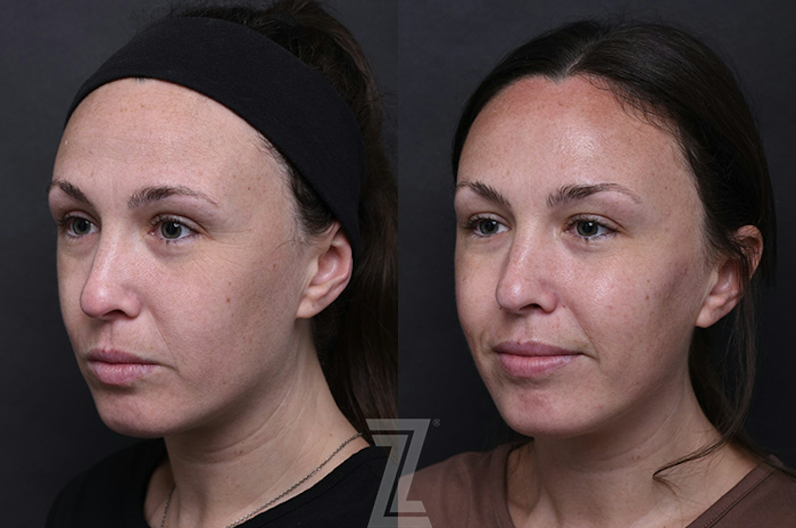 Austin Wrinkle Relaxers Before & After Gallery - Patient 325403 - Image 2 - The Piazza Center