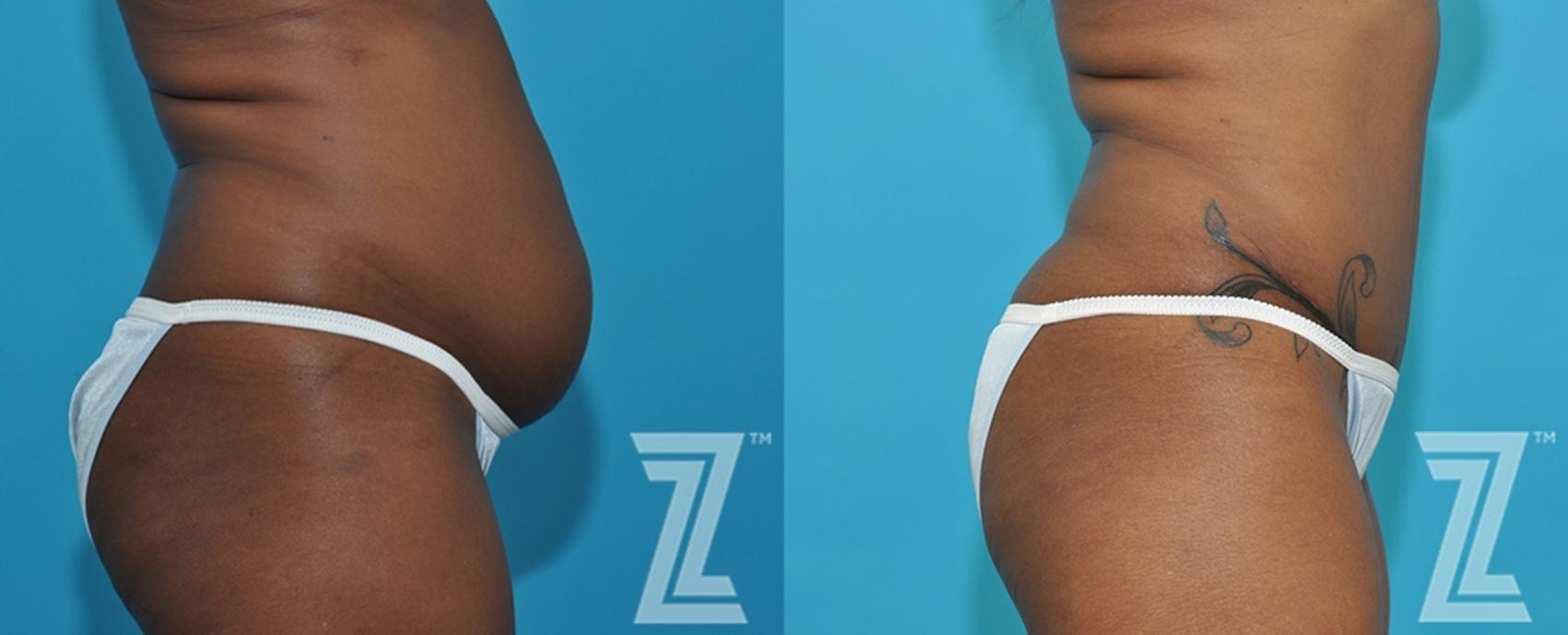 Austin Side Abdomen view of 43-year-old mother of two mommy maker over - Dr. Rocco Piazza - The Piazza Center
