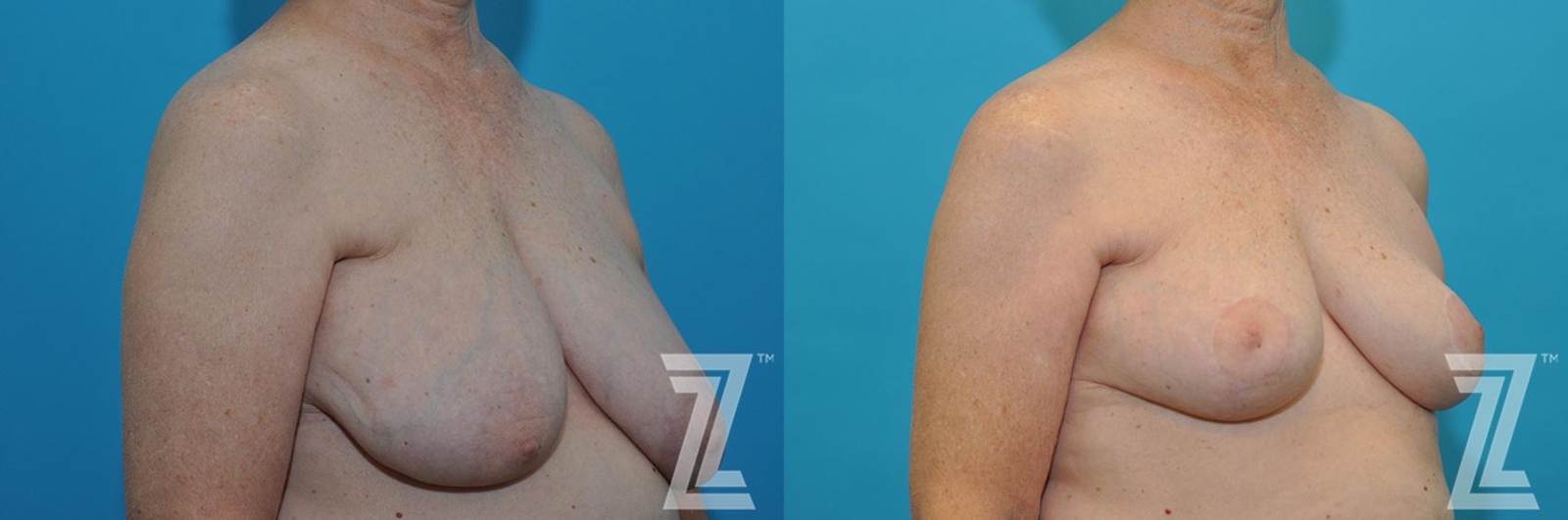 Austin Correction of Breast Asymmetry Before & After Gallery - Patient 132886776 - Image 4 - The Piazza Center