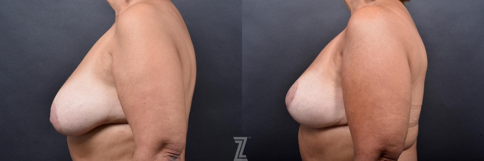 Austin Breast Lift Before & After Gallery - Patient 132791067 - Image 3 - The Piazza Center