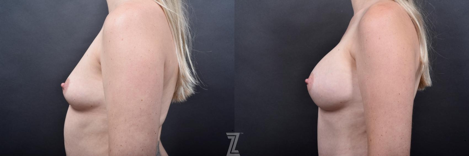 Austin Lateral View of Breast of 29-Year-Old Mommy Makeover Before & After by Dr. Rocco Piazza in Austin, Texas - The Piazza Center
