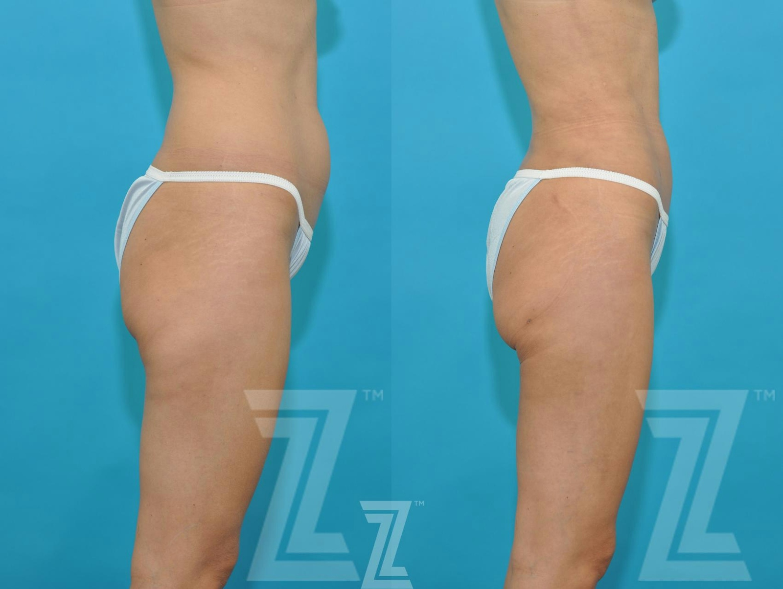 Austin Liposuction Before & After Gallery - Patient 132893822 - Image 4 - The Piazza Center