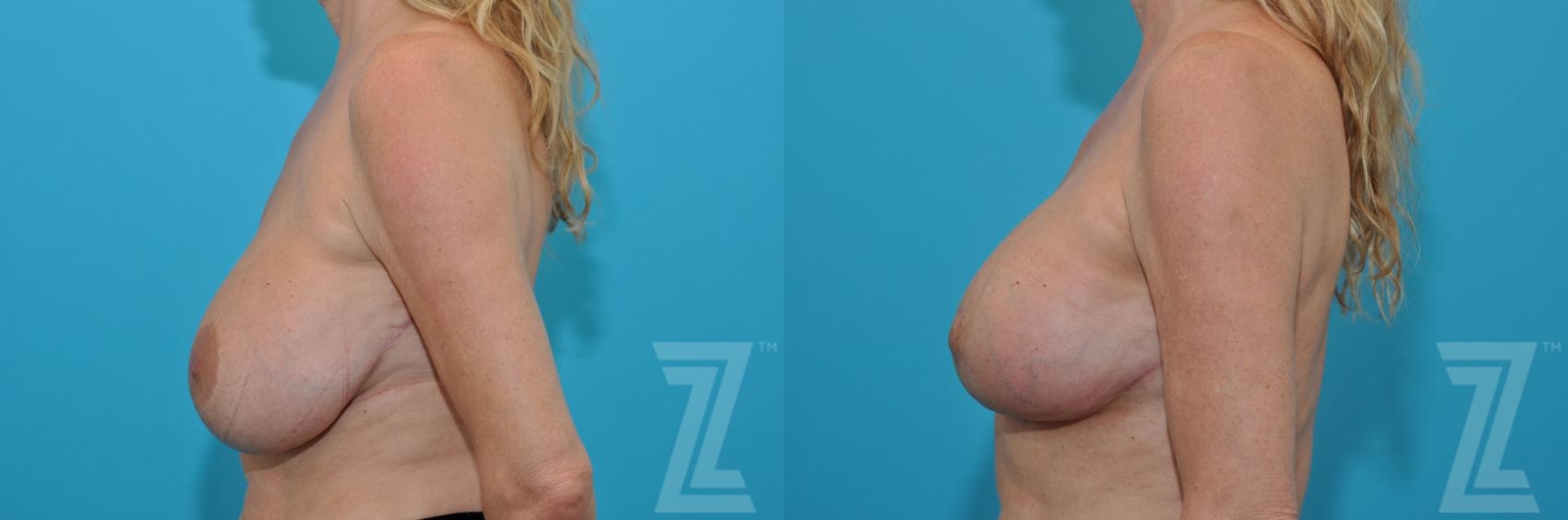 Austin Breast Augmentation Revision Before & After Gallery - Patient 132886579 - Image 3 - The Piazza Center