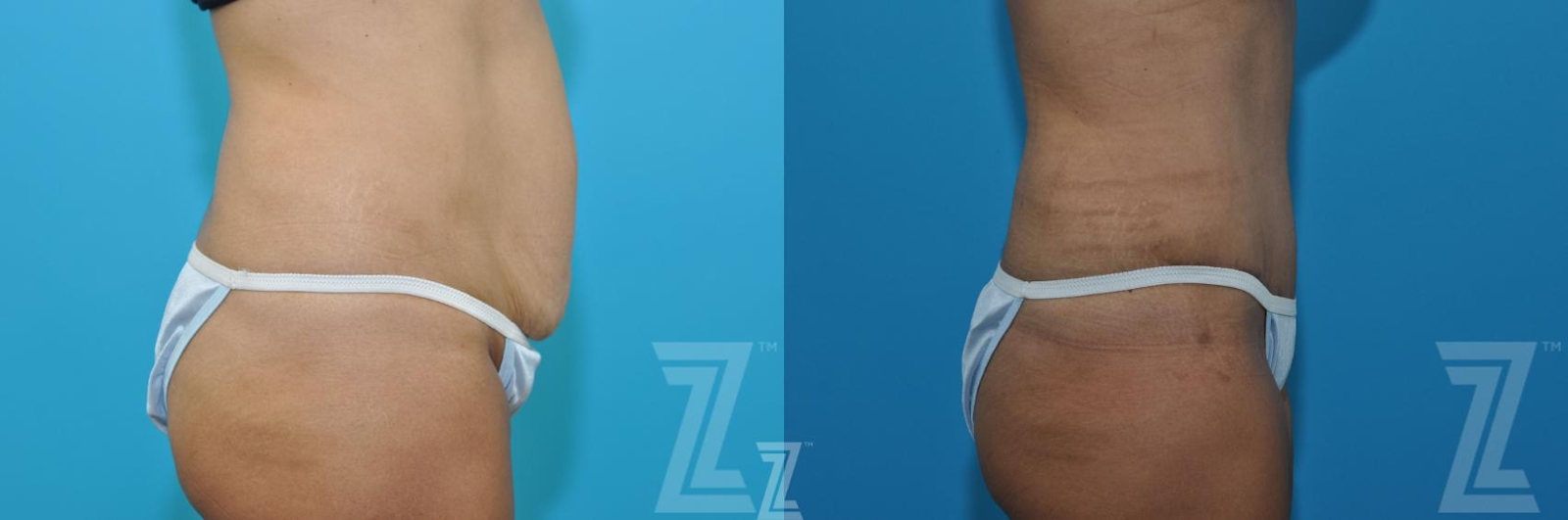 Austin Tummy Tuck Before & After Gallery - Patient 132886898 - Image 4 - The Piazza Center