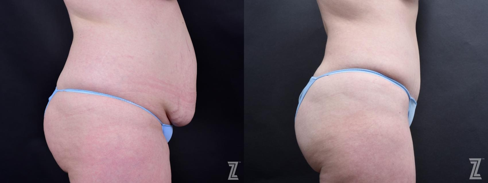 Austin Tummy Tuck Before & After Gallery - Patient 132886803 - Image 4 - The Piazza Center