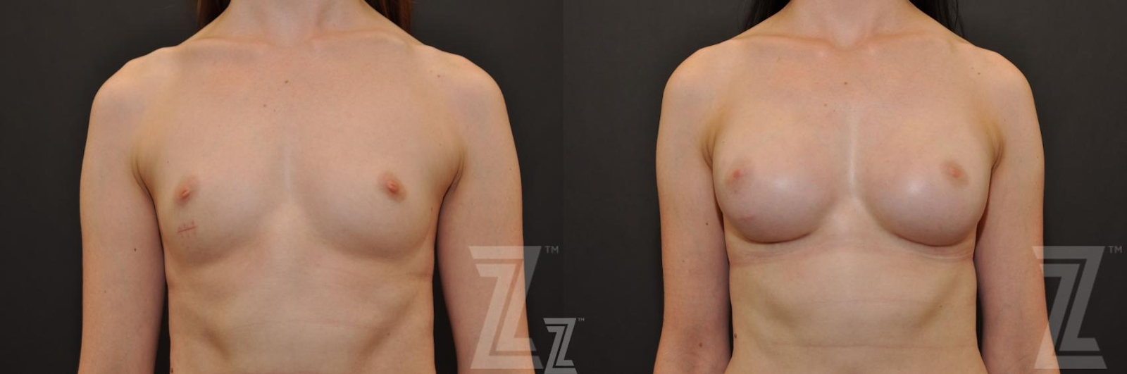 Austin Breast Reconstruction Before & After Gallery - Patient 132886774 - Image 1 - The Piazza Center