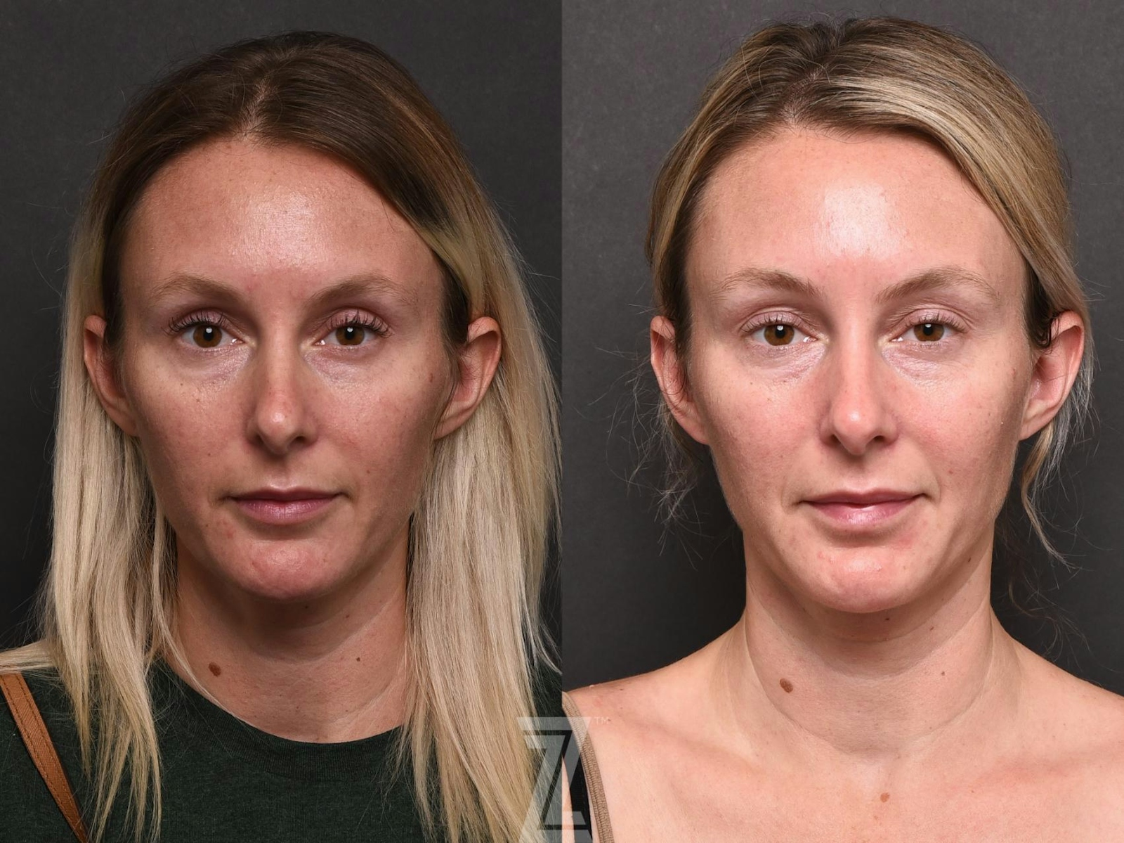 Austin BBL Before & After Gallery - Patient 132963253 - Image 1 - The Piazza Center