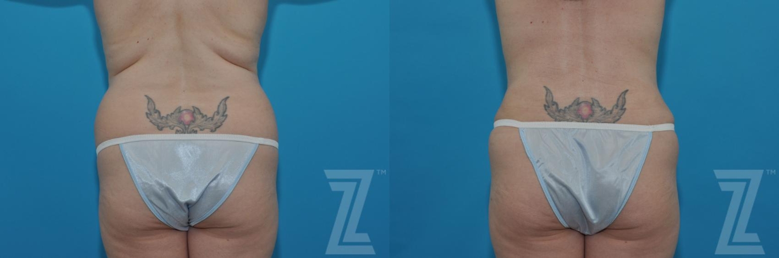 Austin Tummy Tuck Before & After Gallery - Patient 132886813 - Image 6 - The Piazza Center