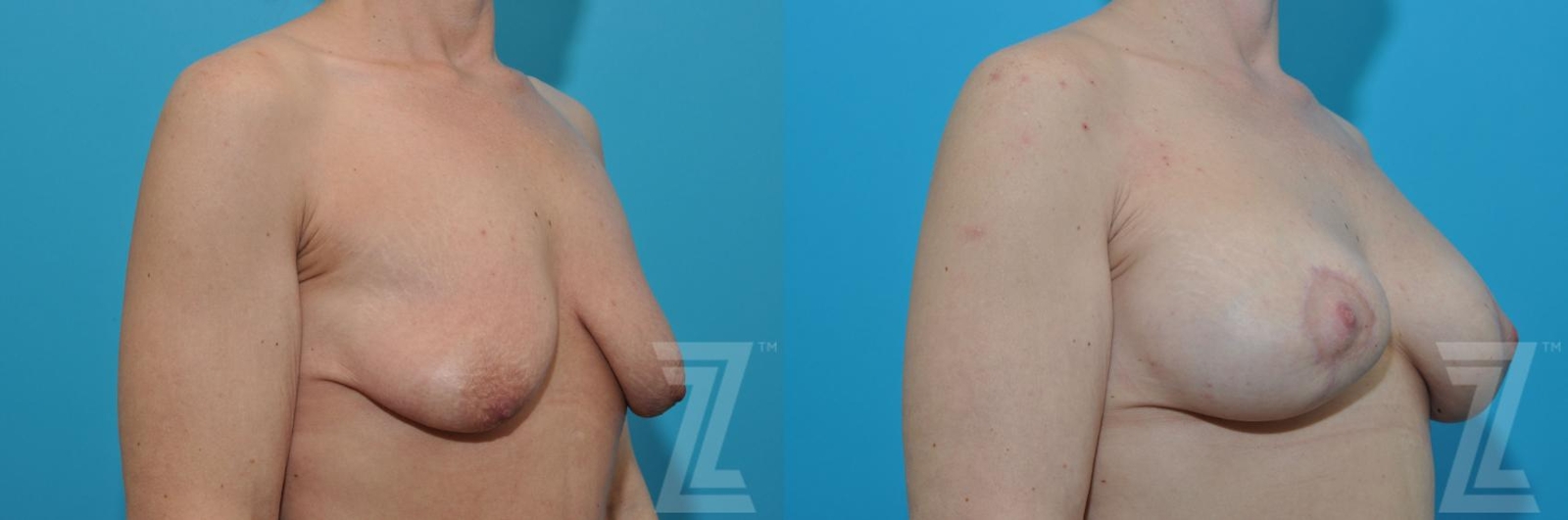 Austin Breast Augmentation With a Breast Lift Before & After Gallery - Patient 132791127 - Image 4 - The Piazza Center