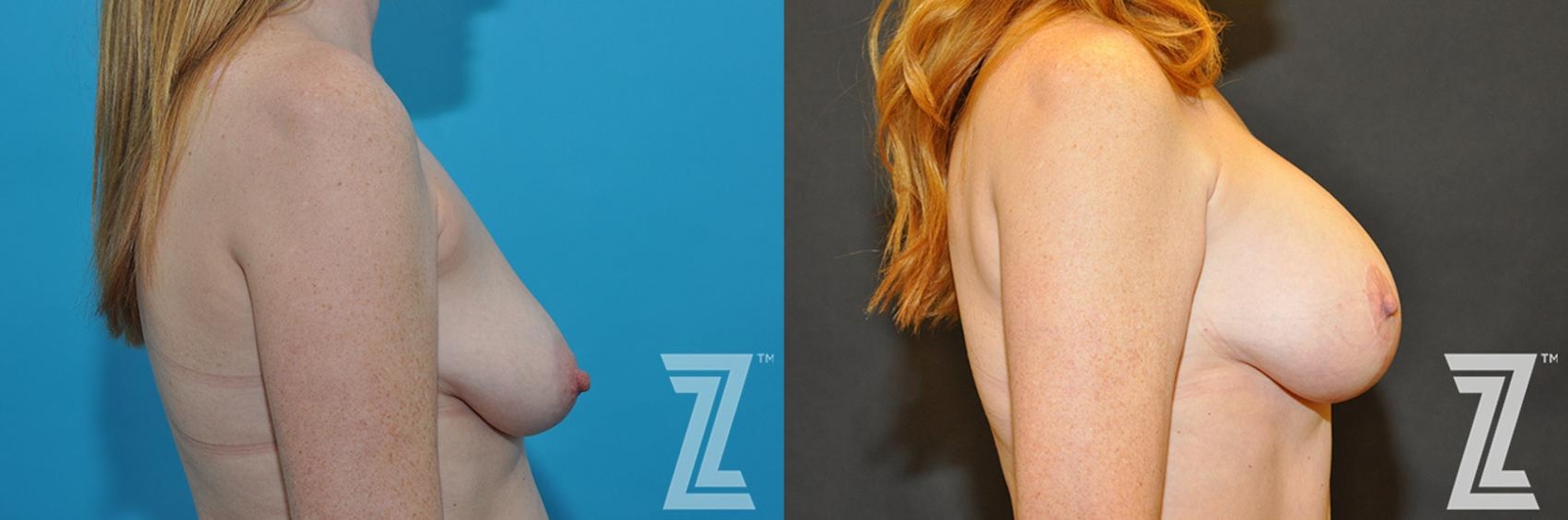 Austin Correction of Breast Asymmetry Before & After Gallery - Patient 132886778 - Image 5 - The Piazza Center