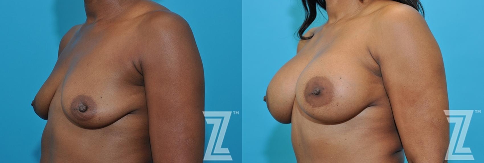 Austin Oblique breast view of 43-year-old mother of two mommy maker over - Dr. Rocco Piazza - The Piazza Center