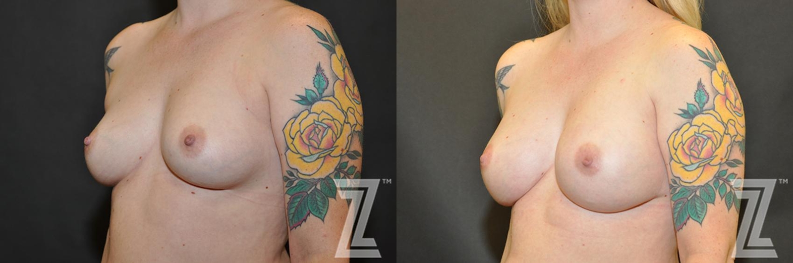 Austin Breast Reconstruction Before & After Gallery - Patient 132886770 - Image 2 - The Piazza Center