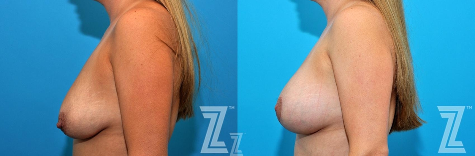 Austin Side breast view before and after images 36 year old woman 1 year post op mommy makeover - Austin Tx, The Piazza Center - The Piazza Center
