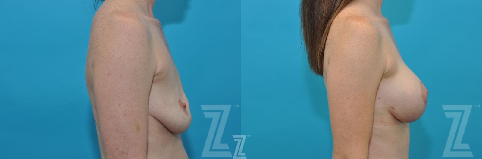 Austin Lateral Breast view before & after images of 35 year old woman mommy make over - Dr. Rocco Piazza Austin TX - The Piazza Center